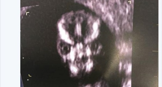 صورة مروعة لجنين تعرضه للسخرية قبل ولادته