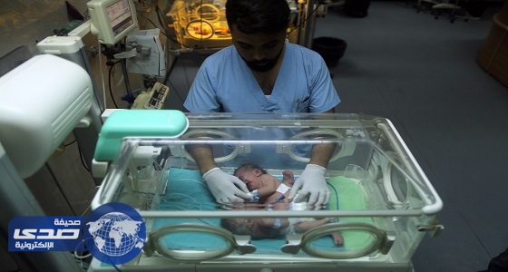 بالصور.. ولادة نادرة لتوأم سيامي في غزة
