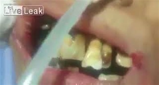 فيديو مرعب لطبيب يعثر على ديدان في فم مريضة