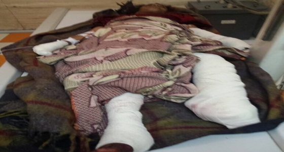 بتر ساق طفلة وإصابة أخرى في لغم للحوثيين باليمن