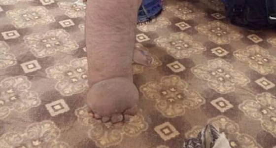 بالصور.. لدغة بعوضة تحول ساق فتاة لـ &#8221; رجل فيل &#8220;