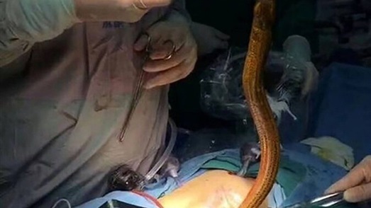 فيديو صادم للحظة استخراج ثعبان بحر من أمعاء مريض