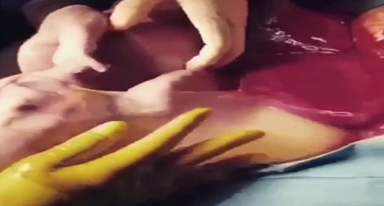 بالفيديو.. ولادة نادرة لطفل داخل الكيس الأمنيوسي