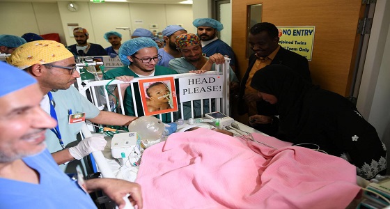 بالصور.. نجاح عملية فصل التوأم السوداني بمستشفى الملك عبدالله