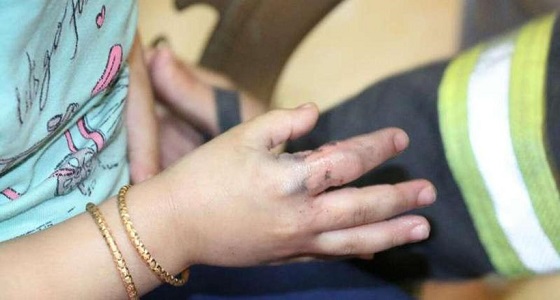 تحرير أصبع فتاة وطفل من خاتم علق بهما بالعاصمة المقدسة