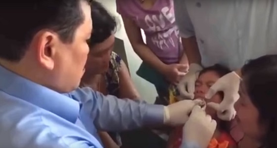 بالفيديو.. رجل يعالج طفلة مصابة بالصم والبكم بطريقة غريبة
