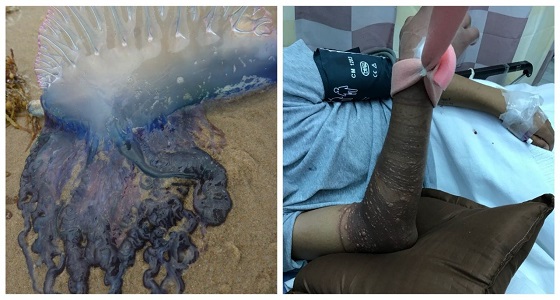 صحة عسير: قنديل البحر تسبب في تورم وجروح في ذراع شاب