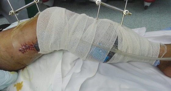 بعد حادث مأسوي .. &#8221; سعود الطبية &#8221; تنقذ ثلاثيني من بتر قدمه المعلقة بالجلد