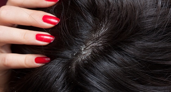 وصفة سحرية لعلاج قشرة الشعر في وقت قياسي