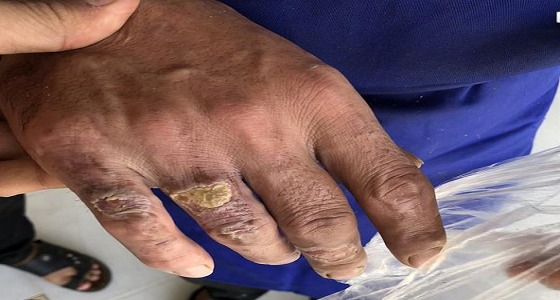 بالصورة.. عامل بمطعم يباشر عمله رغم إصابة يديه.. والرقابة تبحث عنه