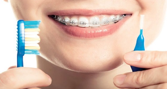 4 نصائح تساعدك في الحفاظ على أسنانك خلال &#8221; التقويم &#8220;