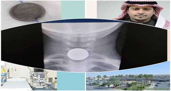 مستشفى ” الملك سعود ” تنقذ طفل ابتلع قطعة معدنية دون جراحة