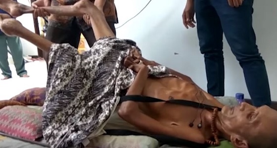 فيديو صادم لجسد رجل يتحول إلى لوح خشب بعد 24 عاما من حادث مأساوي