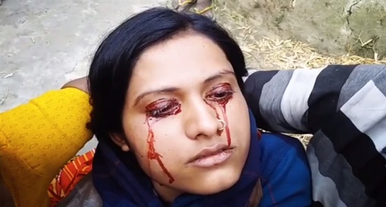 فيديو مروع لفتاة تتعرق دما من عينيها