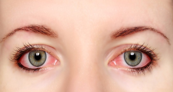 10 أسباب رئيسية لاحمرار العين وطرق علاجها