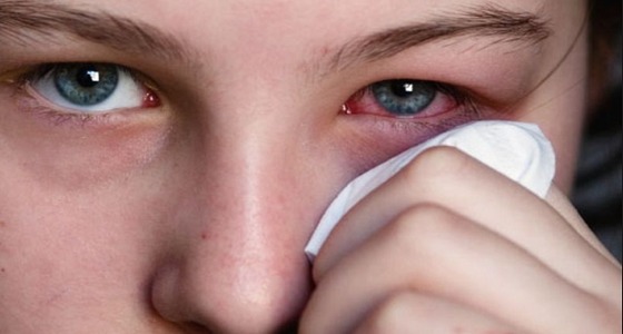6 نصائح تجنبك أحمرار العين