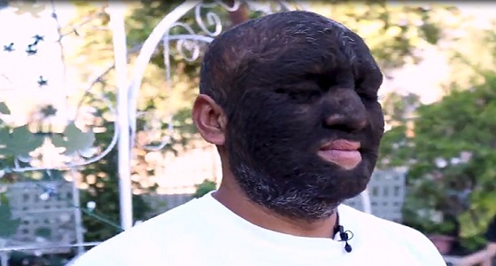 بالفيديو.. أكثر رجل مُشعِر في العالم