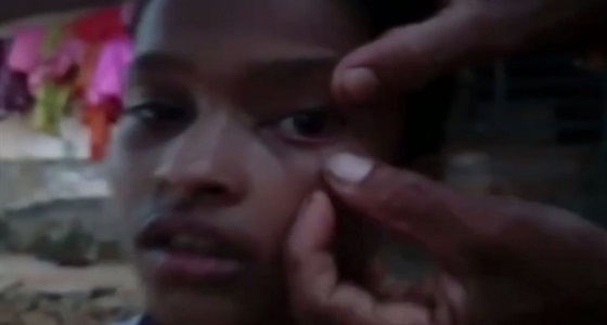 بالفيديو.. لحظة إزالة 60 نملة من عين طفلة