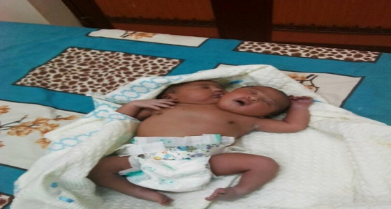 ولادة طفل برأسين في السودان