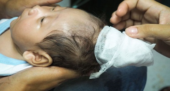 بالفيديو.. ولادة نادرة لطفل رضيع بقرن في رأسه