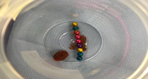 فريق طبي ينجح في إزالة ٩كرات صغيرة ممغنطة من باطن طفلة