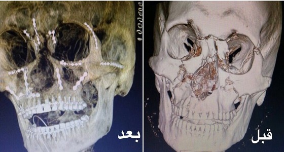 فريق طبي بمدينة الملك سعود يعيد ترميم جبهة مواطن تعرض لحادث