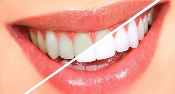أبرزها الأسنان الطبيعية.. اشتراطات هامة يتطلبها ” تبييض الأسنان “
