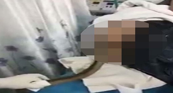 بالفيديو.. أطباء يزيلون ثعبان بحر من رجل