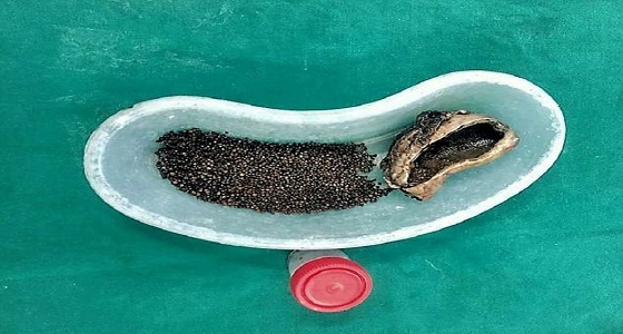 بالصور.. أطباء يزيلون 4100 حصوة من مرارة مريض