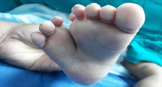 بالصور..نجاح فريق طبي في استئصال قدم ثالثة لرضيعة