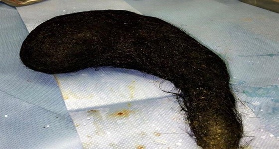 مرض نادر يدفع مواطنة لأكل الشعر.. وإخراج كتلة من معدتها