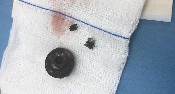 فريق طبي ينجح في استخراج قطعة معدنية من رأس شاب بمدينة الملك سعود