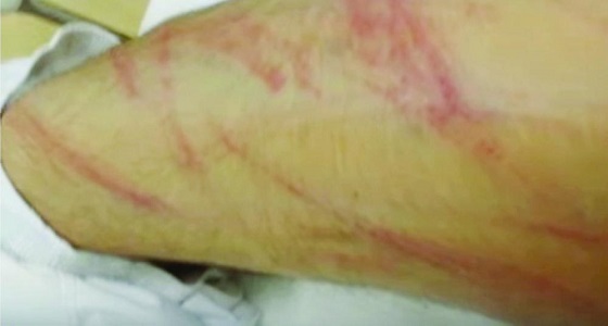 تعنيف نزيلا بـ ” تأهيل القنفذة ” وحرقه بمادة ساخنة