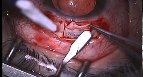 تدشين خدمات جديدة لمرضى العيون بمجمع الملك فيصل الطبي بالطائف