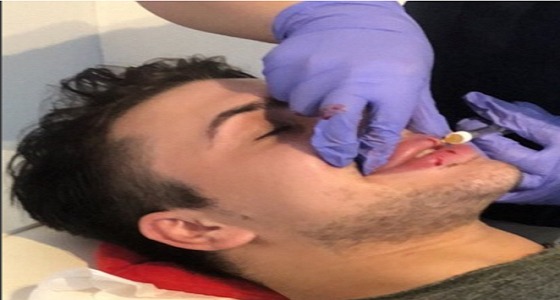 بالصور.. شاب لجأ لتكبير شفتيه وكانت النهاية مروعة