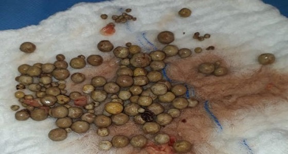 بعد معاناة 6 سنوات.. فريق طبي يستخرج 87 حصوة من مثانة مريض بالقريات