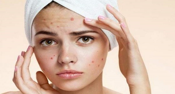 خبراء: حب الشباب في هذه المنطقة من الوجه قد يكون مميتا