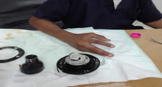 بالصور.. إنقاذ يد طفل علقت بفتحة خزان وقود سيارة في الجوف