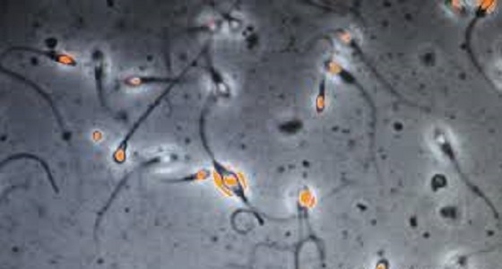 تجارب فعالة لعلاج سرطان الرحم بحقن الحيوانات المنوية