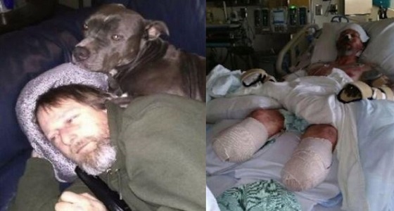 بالصور.. رجل يفقد أطرافه الأربعة بسبب حبه للكلاب