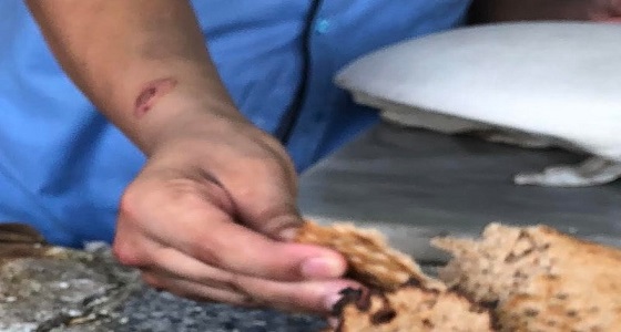 بالصور.. تقرحات في يد عامل بمطعم شعبي أثناء تجهيزه ” العجينة ” بمكة المكرمة