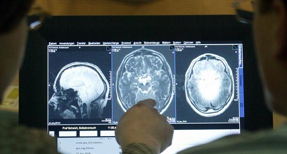 بالفيديو.. لأول مرة علاج جديد لمرضى الصرع بالليزر