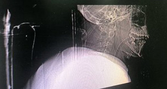 إنقاذ مصاب بتمزق الوريد الوداجي وقطع بالرقبة بالمدينة المنورة