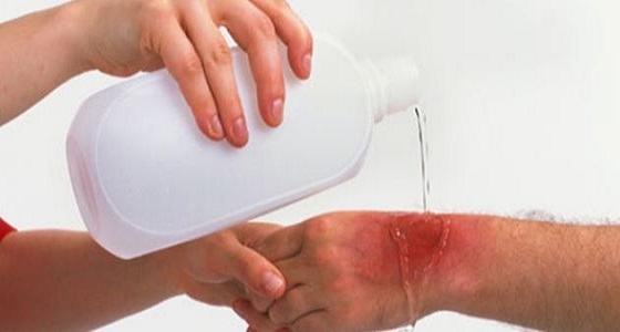 بالفيديو.. الحروق المنزلية وطرق التعامل معها