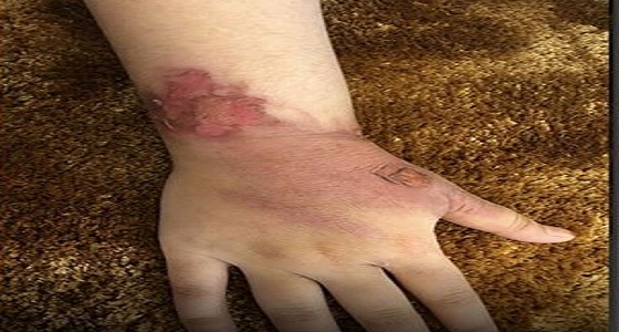 تفاصيل جديدة يرويها ولي أمر الطفلة المصابة بحروق أثناء صبها القهوة بالمدرسة