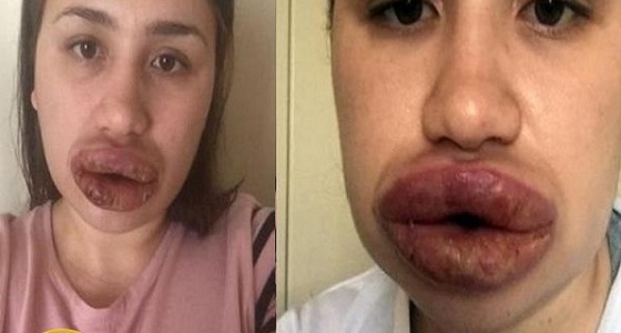 طبيب مزيف يشوه وجه فتاة