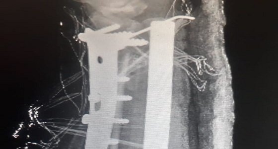 بالصور.. ترميم عظام وافد بمستشفى بدر بعد تفتتها في حادث سير