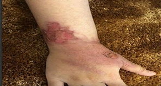 بالفيديو.. ” تعليم عسير ” تعتذر عن إصابة طفلة بحروق في مدرسة