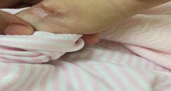 حديثة ولادة تتعرض لتآكل وتشققات بأطرافها.. وصحة مكة تحقق