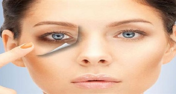 أسباب الهالات السوداء وكيفية التخلص منها